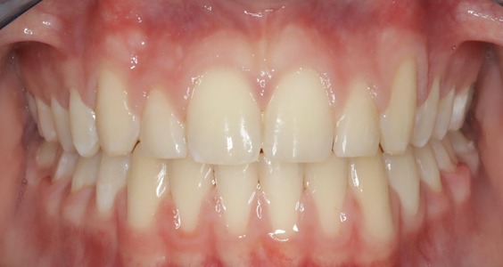 After Teeth